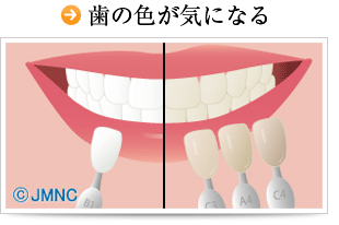 歯の色が気になる