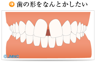 歯の形をなんとかしたい