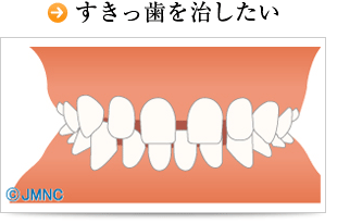 すきっ歯を治したい