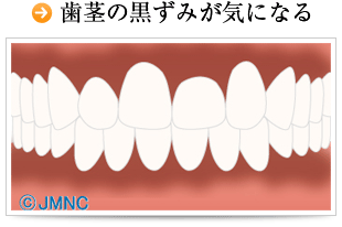 歯茎の黒ずみが気になる